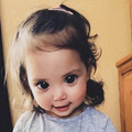 Axenfeld-Rieger_syndrome.jpg